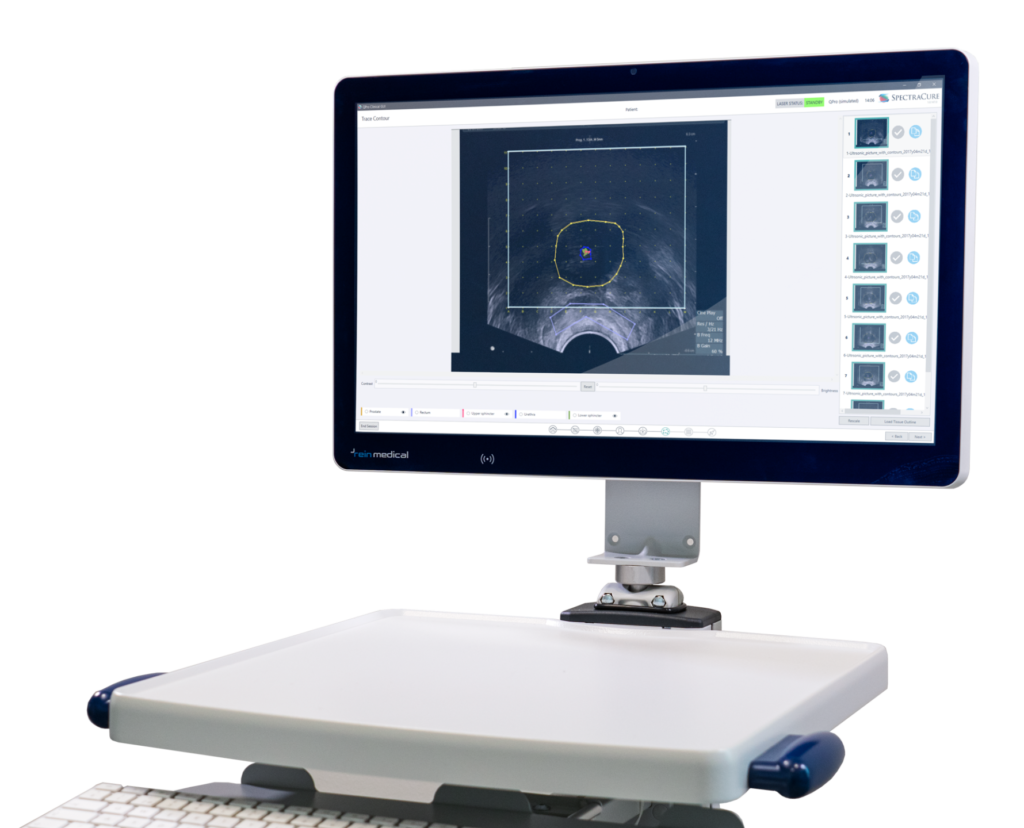 SpectraCures egenutvecklade behandlingssystem, P18, för behandling av prostatacancer.