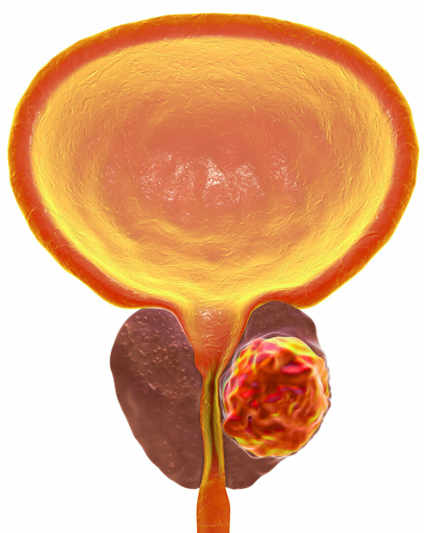 En klinisk prövning för lokalt återkommande prostatacancer